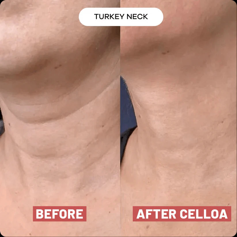 The Cellôa™ Lift - Become the Woman Who Loves Her Neck Again