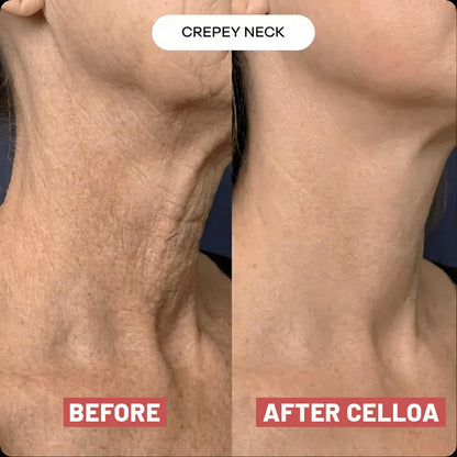 The Cellôa™ Lift - Become the Woman Who Loves Her Neck Again