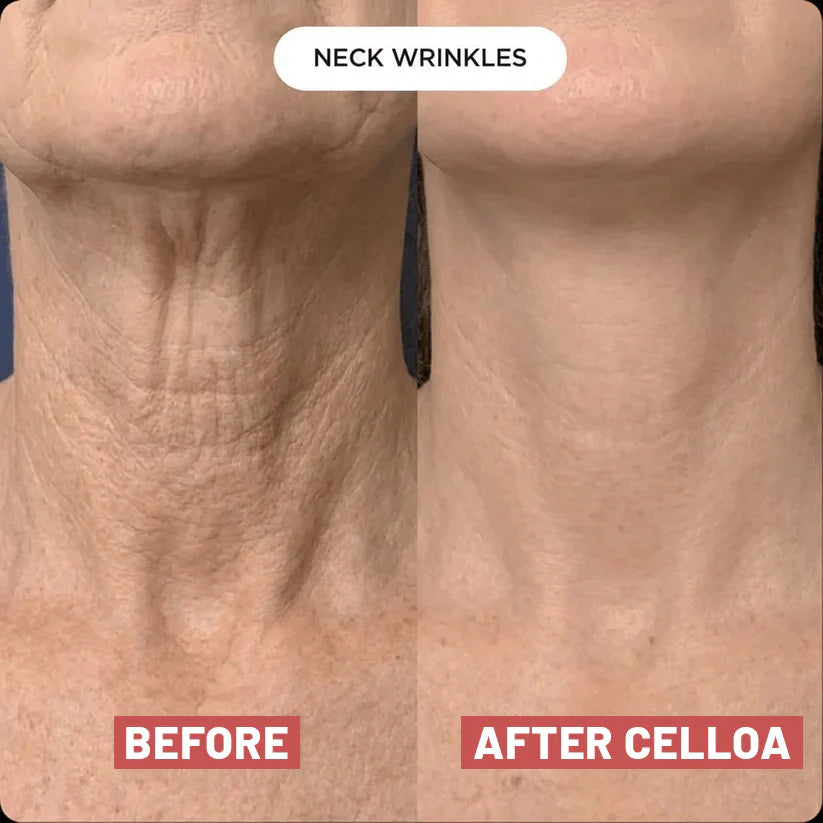 The Cellôa™ Lift - Become the Woman Who Loves Her Neck Again