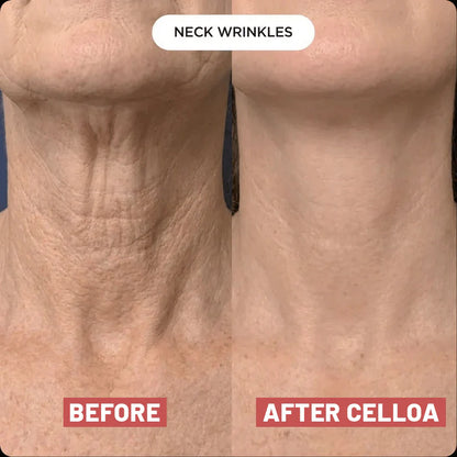 The Cellôa™ Lift - Become the Woman Who Loves Her Neck Again